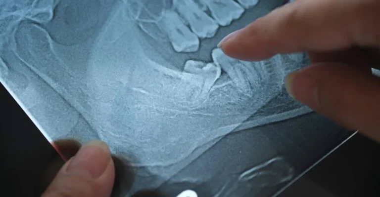 Saying Goodbye to Wisdom Teeth