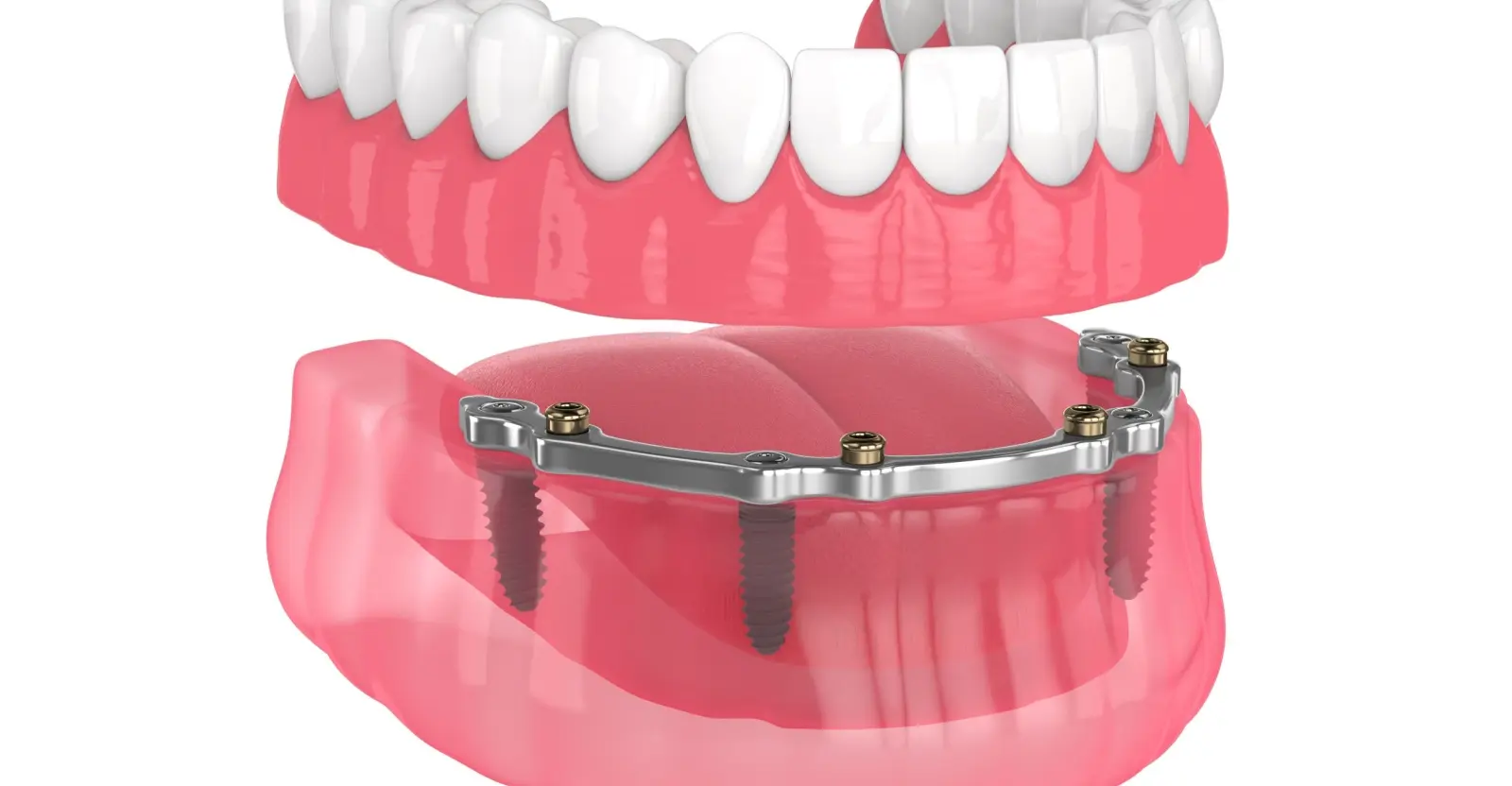 bar attachment denture