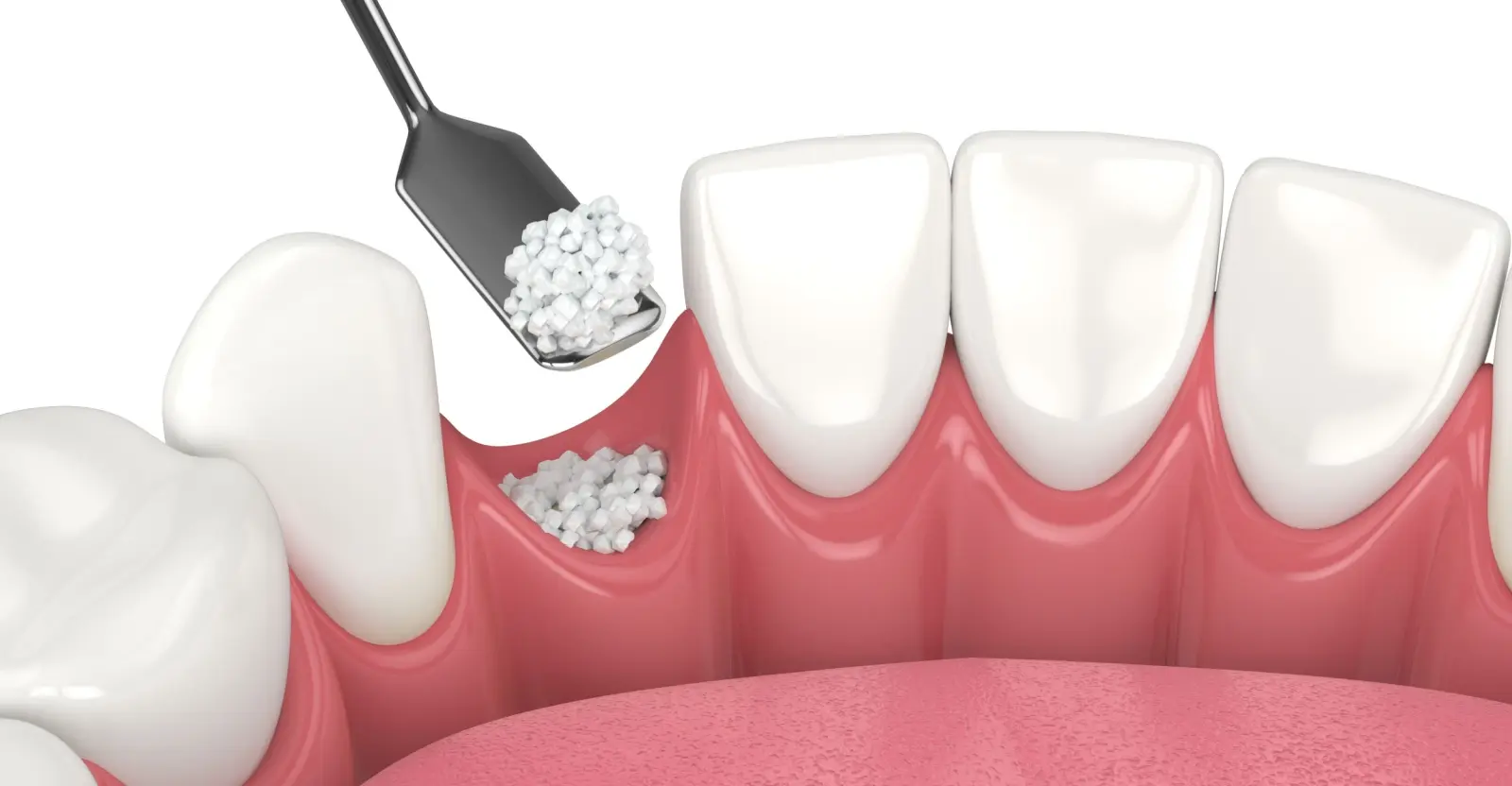 bone graft