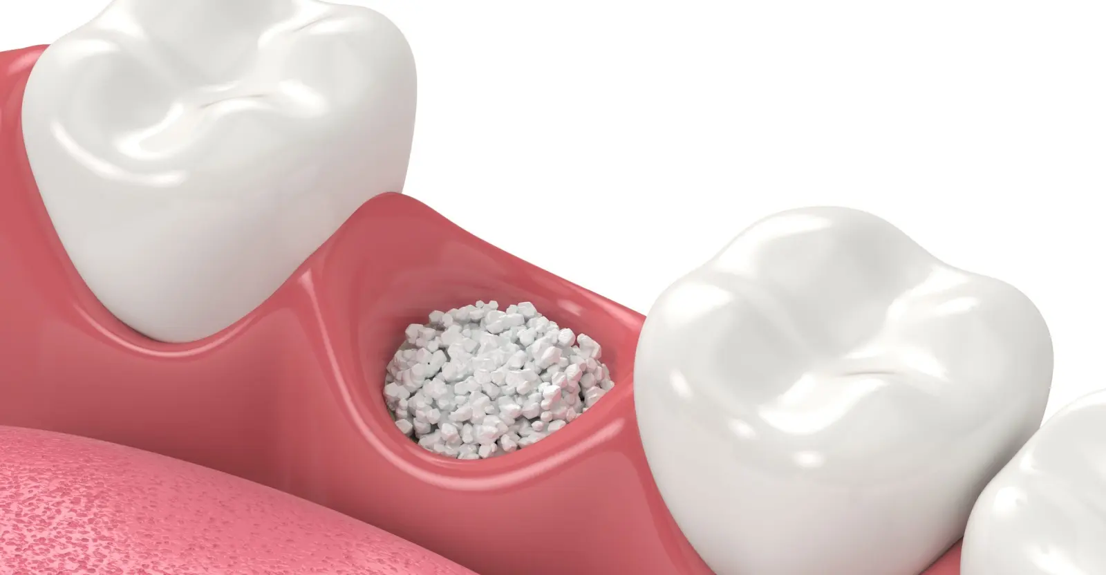 bone grafting