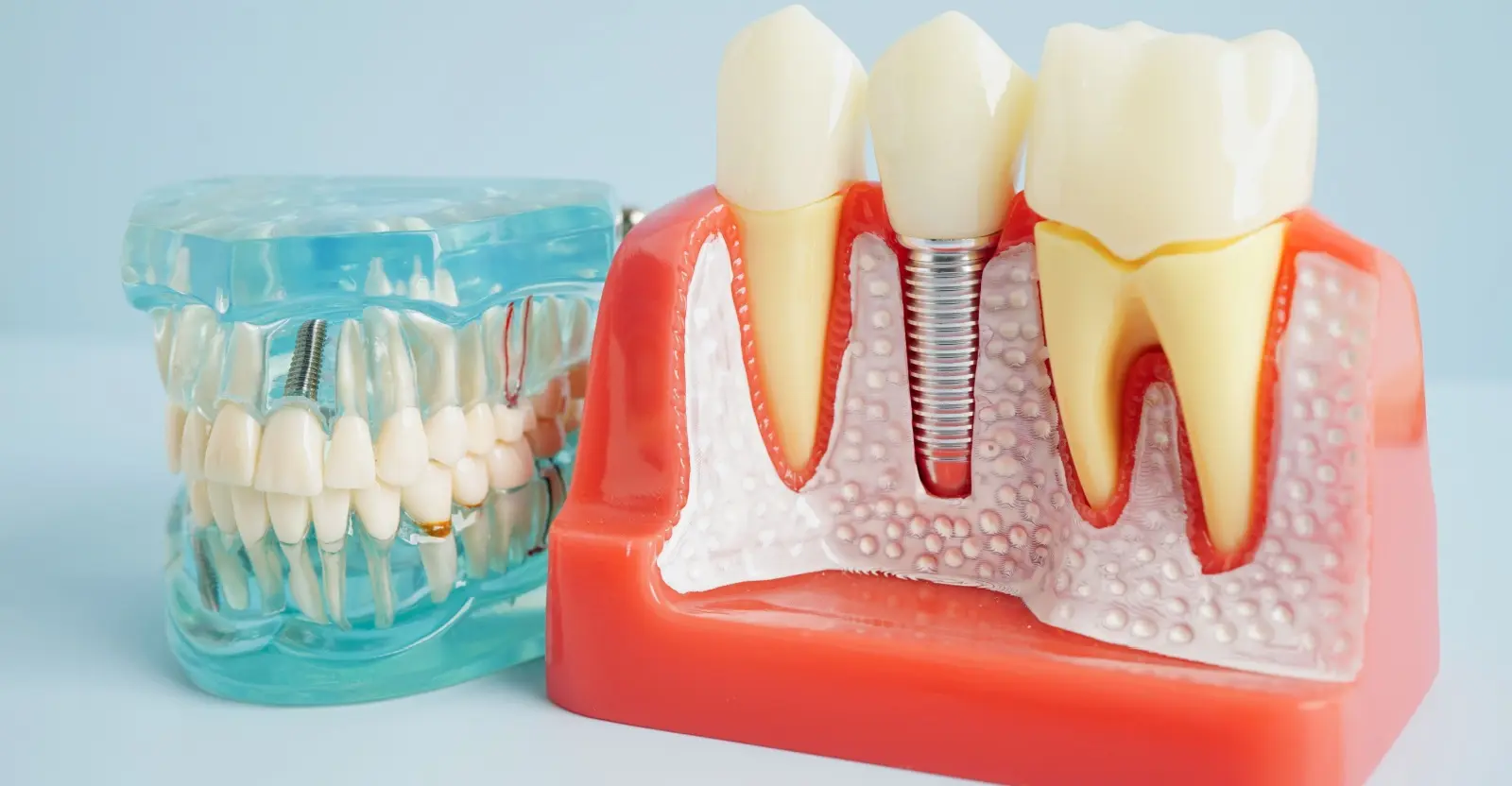 dental implants