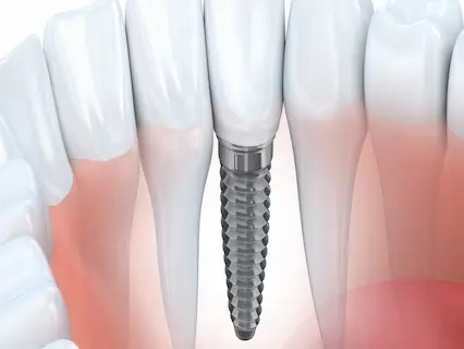 dental-implant-healing-stages after implant placement
