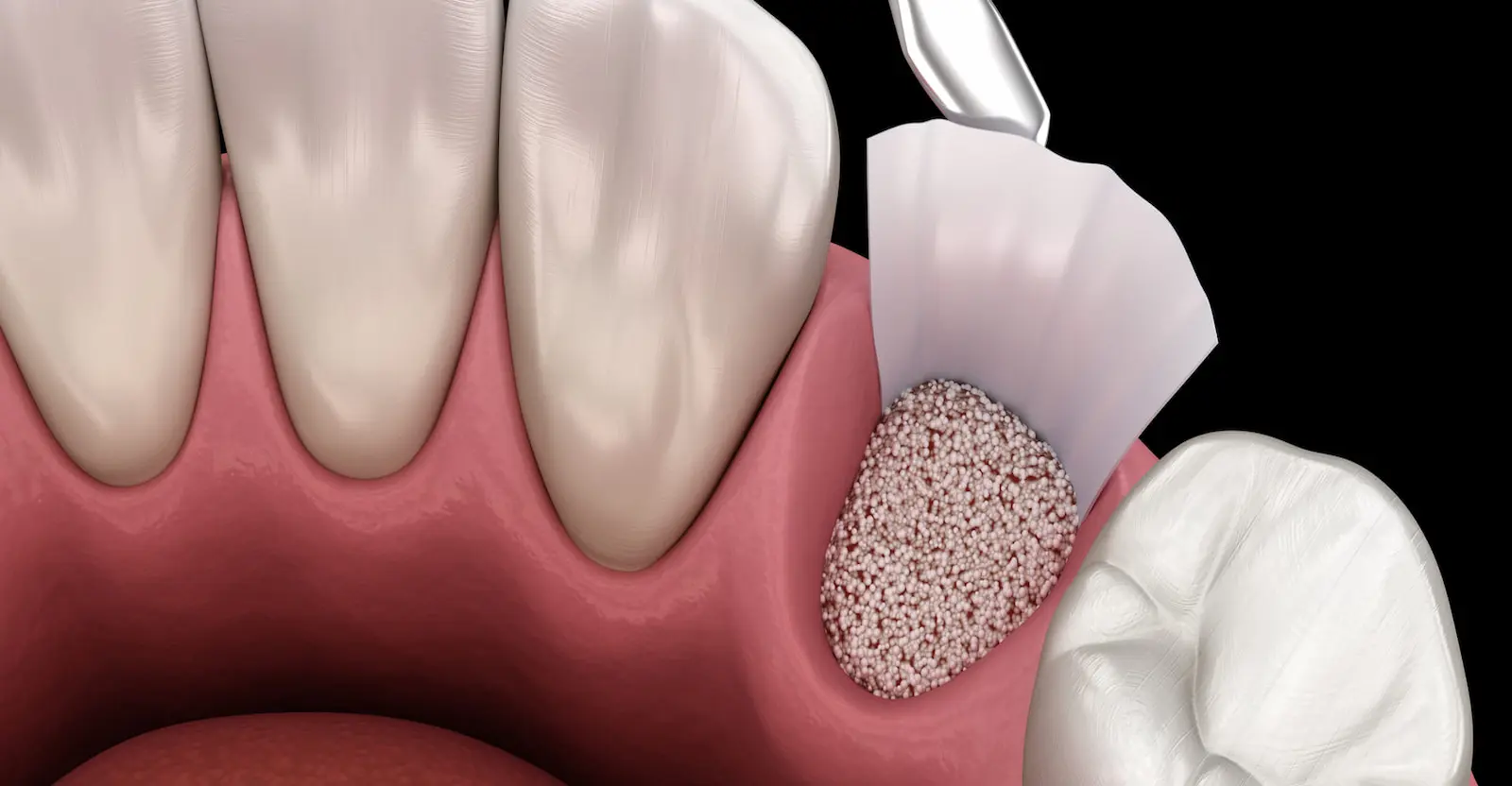 bone grafting