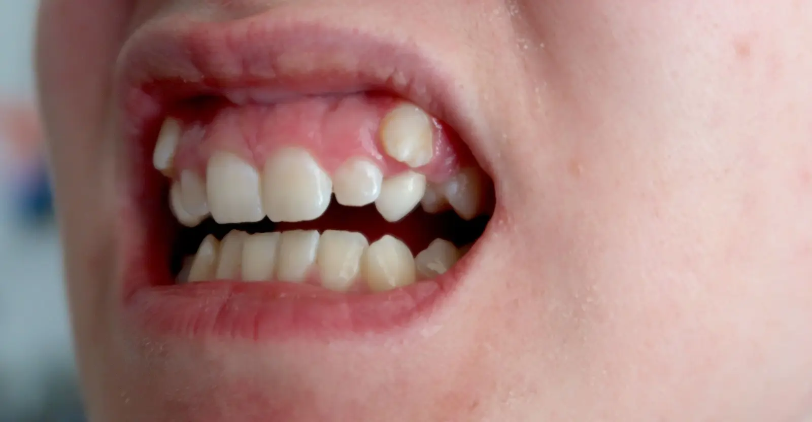 impacted canines