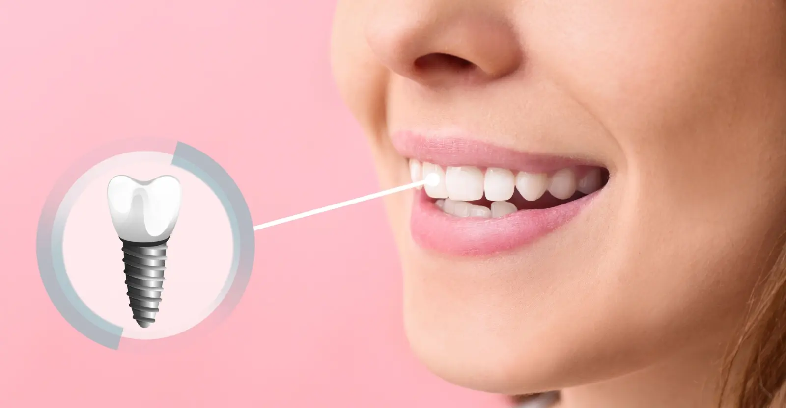 dental implant placement