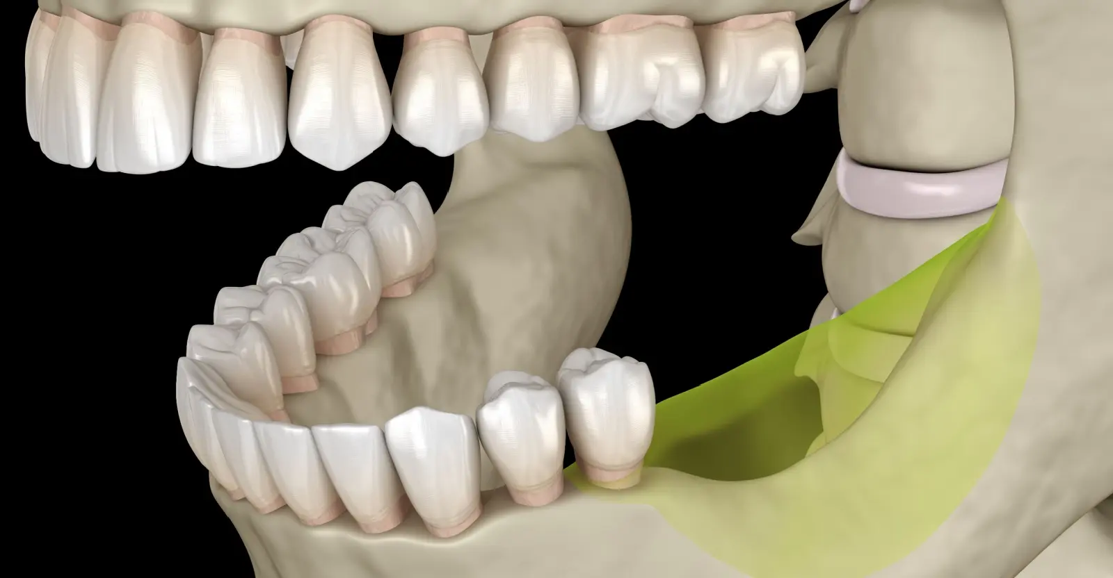 jaw bone loss