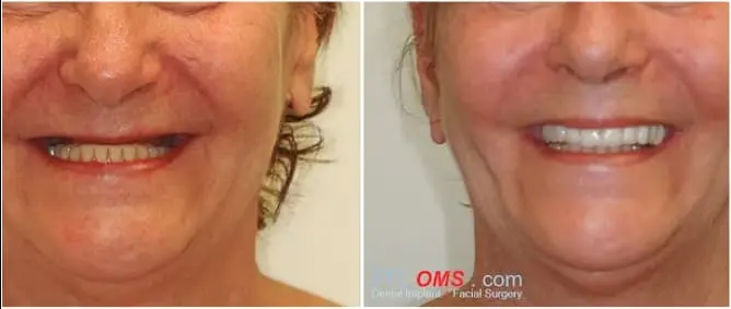 Teeth in a Day | Before and  After
