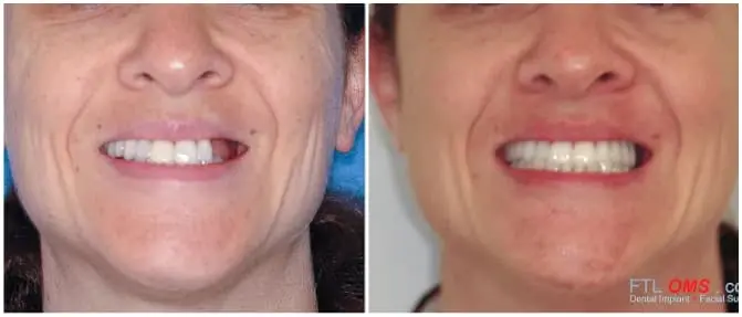 Dental Implants | Before & After