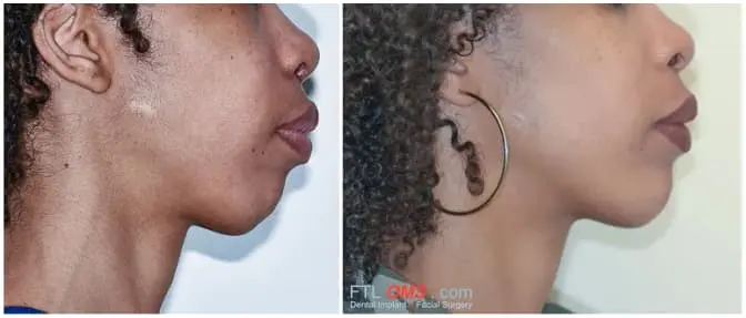 Jaw Surgery | Before & After