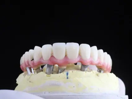 All-on-4 Dental Implants row 1 - Impland and Facial Surgery.webp All-on-4 Dental Implants row 1 - Implant and Facial Surgery.webp