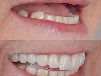 Beyond Dentures Replace Missing Teeth with All-on-4 - Implant and Facial Surgery Can Help Beyond Dentures Replace Missing Teeth with All-on-4 - Implant and Facial Surgery Can Help