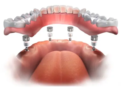 How All-on-4 Dental Implants Work - Implant and Facial Surgery Shows You How How All-on-4 Dental Implants Work - Implant and Facial Surgery Shows You How