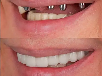 The Basics of Multiple Teeth Implants - Implant and Facial Surgery Explains The Basics of Multiple Teeth Implants - Implant and Facial Surgery Explains