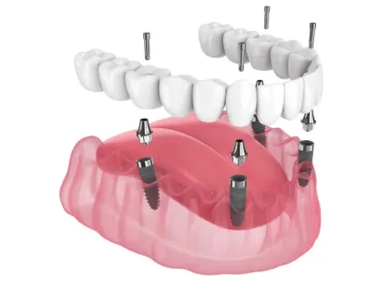Types of Multiple-Teeth Implants Row 3- Implant and Facial Surgery Types of Multiple-Teeth Implants Row 3- Implant and Facial Surgery