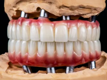 Full Mouth Impants Row 1 - Implant and Facial Surgery.webp Full Mouth Impants Row 1 - Implant and Facial Surgery.webp