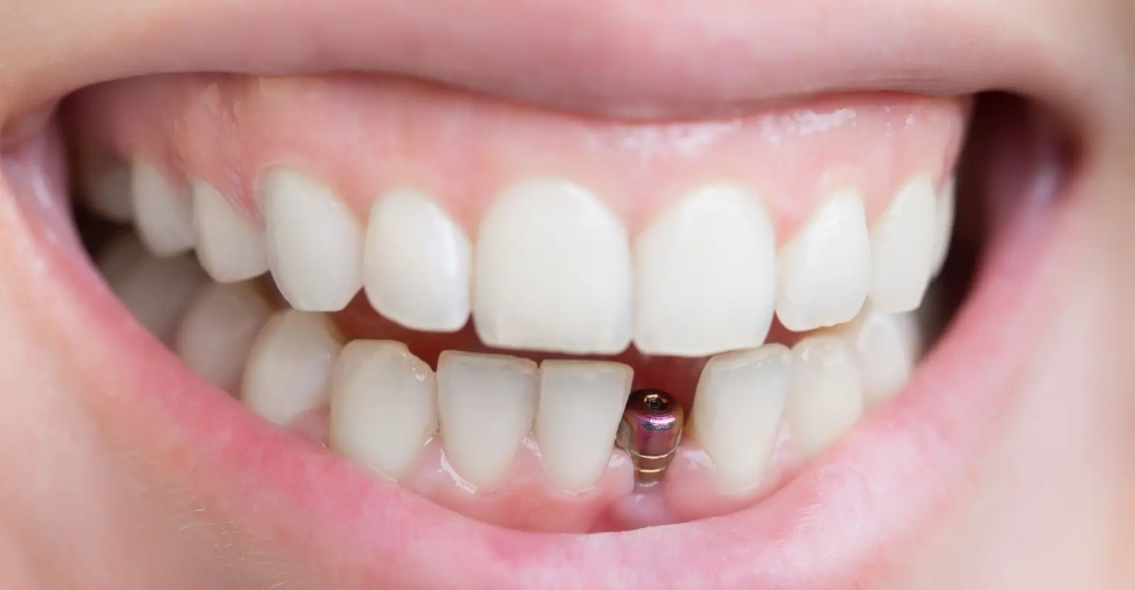 Single Tooth Implants Hero - Implant and Facial Surgery