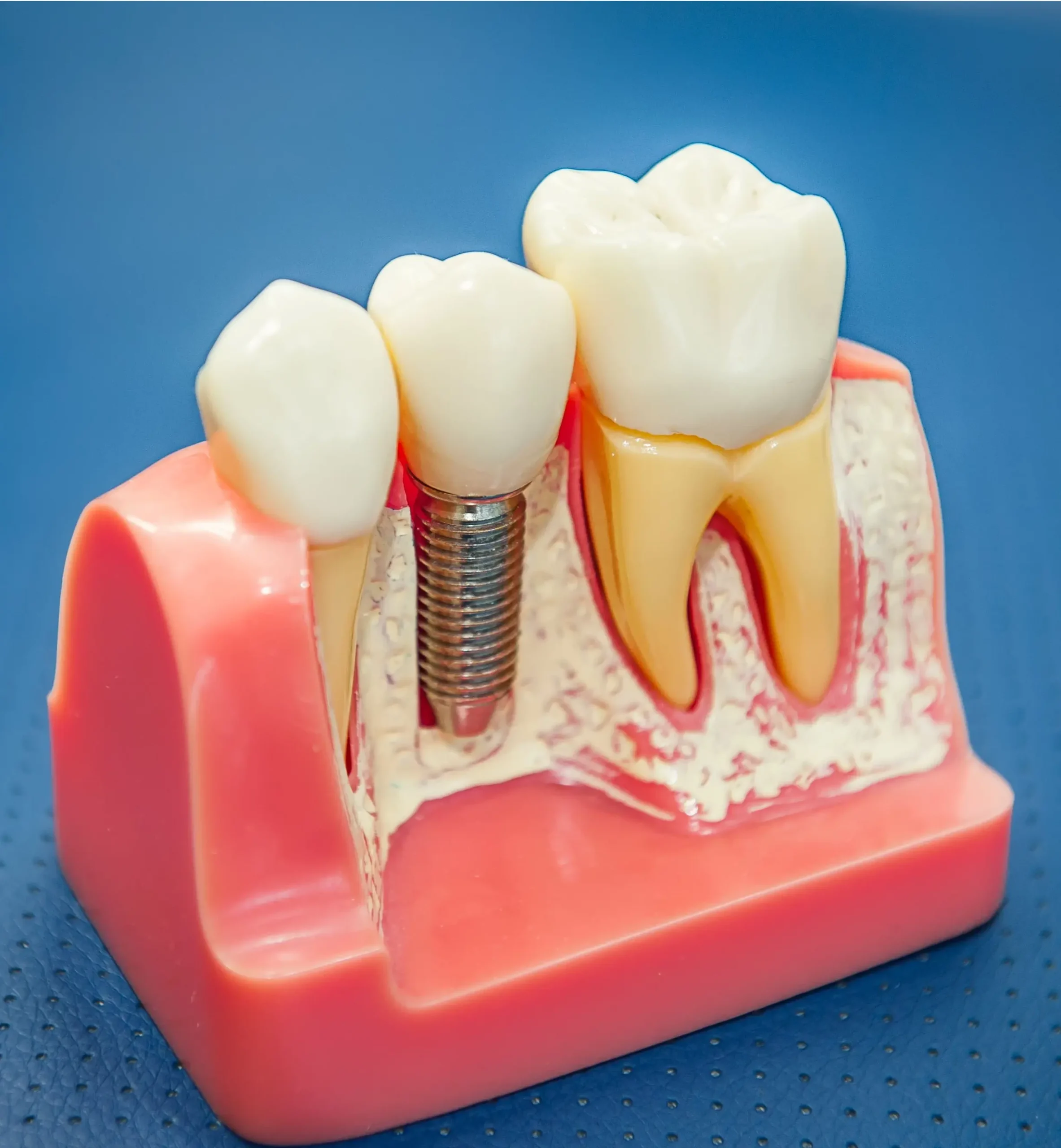 Single Tooth Implants - Implant and Facial Surgery .webp Single Tooth Implants - Implant and Facial Surgery .webp