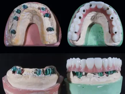 The Full Mouth Dental Implant Procedure - Implant and Facial Surgery Explains The Full Mouth Dental Implant Procedure - Implant and Facial Surgery Explains