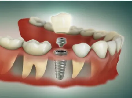 The Single Tooth Implant Procedure - Implant and Facial Surgery Gives Step by Step Instructions The Single Tooth Implant Procedure - Implant and Facial Surgery Gives Step by Step Instructions