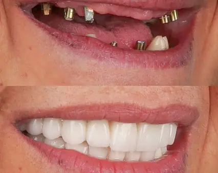 Who Is a Good Candidate for Dental Implants - Implant and Facial Surgery Can Tell You If Implants Are Right for You Who Is a Good Candidate for Dental Implants - Implant and Facial Surgery Can Tell You If Implants Are Right for You